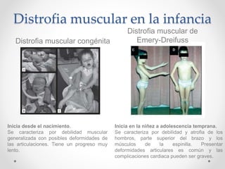 Espina Bifida y Distrofia Muscular | PPTX