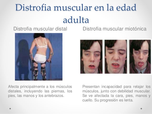 Espina Bifida y Distrofia Muscular Espina Bifida y Distrofia Muscular
