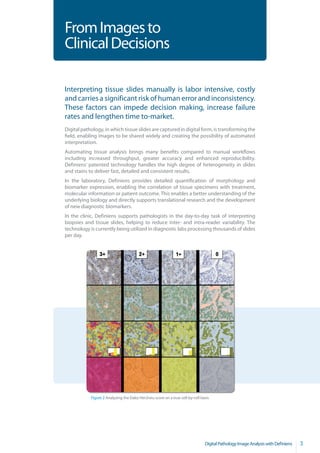 From Images to
Clinical Decisions

Interpreting tissue slides manually is labor intensive, costly
and carries a significant risk of human error and inconsistency.
These factors can impede decision making, increase failure
rates and lengthen time to-market.
Digital pathology, in which tissue slides are captured in digital form, is transforming the
field, enabling images to be shared widely and creating the possibility of automated
interpretation.
Automating tissue analysis brings many benefits compared to manual workflows
including increased throughput, greater accuracy and enhanced reproducibility.
Definiens’ patented technology handles the high degree of heterogeneity in slides
and stains to deliver fast, detailed and consistent results.
In the laboratory, Definiens provides detailed quantification of morphology and
biomarker expression, enabling the correlation of tissue specimens with treatment,
molecular information or patient outcome. This enables a better understanding of the
underlying biology and directly supports translational research and the development
of new diagnostic biomarkers.
In the clinic, Definiens supports pathologists in the day-to-day task of interpreting
biopsies and tissue slides, helping to reduce inter- and intra-reader variability. The
technology is currently being utilized in diagnostic labs processing thousands of slides
per day.




            Figure 2 Analyzing the Dako Her2neu score on a true cell-by-cell basis




                                                                               Digital Pathology Image Analysis with Definiens   3
 