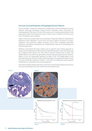 Use Case: Survival Prediction of Esophageal Cancer Patients
                        In this example, a study was conducted in collaboration with the Helmholtz Institute
                        (Munich, Germany) comparing manual H-score evaluation (Dako Herceptest) of
                        esophagogastric TMA cores. The aim of the study was to stratify patients based on the
                        expression profile of IHC Dako Her2 stain in tumor tissue. A total of 391 tissue cores
                        from 150 patients were analyzed.
                        Figure 3 shows an example TMA core, while figure 4 illustrates Definiens’ classification
                        algorithms which delineate 1) tumor from non-tumor regions of interest 2) nucleus,
                        cytoplasm and membrane cellular attributes and 3) Her2 membrane biomarker
                        expression, providing a comprehensive, multiparametric data set of morphology and
                        Her2neu expression.
                        Definiens used advanced image analysis and an agnostic data mining approach to
                        reveal a set of multiparametric features that stratified the patient cohort retrospectively
                        by correlating these feature sets with clinical outcome (disease free survival). The
                        Kaplan-Meyer curve which was generated using manual semi-quantitative evaluation
                        (figure 5) was not statistically significant (p-value 0.103). The Kaplan-Meyer curve
                        generated using the Definiens image analysis and data mining approach (figure 6) was
                        not only statistically significant (p-value < 4.07e-08), but produced superior patient
                        stratification as compared to the manual approach.
                        The study strongly indicates that there is promise in improving the diagnostic accuracy
                        of tissue-based diagnostics that involve immunohistochemistry.

     Figure 3                                             Figure 4




                                                                          Pathologist Patient Survival Prediction (p < 0.103)                   Pathologist Patient Survival Prediction (p < 4.07e-08)
                                                            1.0




                                                                                                                                      1.0




                                                                                                                                                                               surv. time tresh = 83
                                                            0.8




                                                                                                                                      0.8
                                                                0.6




                                                                                                                                          0.6
                                                       Probability




                                                                                                                                 Probability
                                                      0.4




                                                                                                                                0.4
                                                            0.2




                                                                                                                                      0.2
                                                            0.0




                                                                                                                                      0.0




                                                                      0               50                  100         150                       0             50                  100                  150
                                                                                           Survival Time (month)                                                   Survival Time (month)


                                                           Figure 5                                                                  Figure 6


4   Digital Pathology Image Analysis with Definiens
 