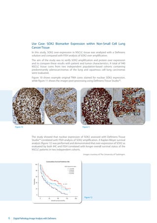 Use Case: SOX2 Biomarker Expression within Non-Small Cell Lung
                        Cancer Tissue
                        In this study, SOX2 over-expression in NSCLC tissue was analyzed with a Definiens
                        solution and compared with FISH analysis of SOX2 over amplification.
                        The aim of the study was to verify SOX2 amplification and protein over expression
                        and to compare these results with patient and tumor characteristics. A total of 940
                        NSCLC tissue cores from two independent population-based cohorts containing
                        predominantly adenocarcinomas of the lung and squamous cell lung carcinomas
                        were evaluated.
                        Figure 10 shows example original TMA cores stained for nuclear SOX2 expression,
                        while figure 11 shows the images post-processing using Definiens Tissue Studio™.




     Figure 10                                                                                                 Figure11



                        The study showed that nuclear expression of SOX2 assessed with Definiens Tissue
                        Studio™ correlated with FISH analysis of SOX2 amplification. A Kaplan-Meyer survival
                        analysis (figure 12) was performed and demonstrated that over-expression of SOX2 as
                        evaluated by both IHC and FISH correlated with longer overall survival status of the
                        NSCLC patients in two independent cohorts.
                                                                                                               Images courtesy of The University of Tuebingen.


                                                 Cummulative Survival Prediction (96)
                                    100
                                                                                 SOX2 expression status
                                                                                           1. quartile
                                        80                                                 2. quartile
                                                                                           3. quartile
                                                                                           4. quartile

                                        60
                          Probability




                                        40
                                                                              p < 0.01



                                        20



                                         0

                                             0      50             100               150                 200
                                                                                                                 Figure 12
                                                         Overall Survival (months)




6   Digital Pathology Image Analysis with Definiens
 