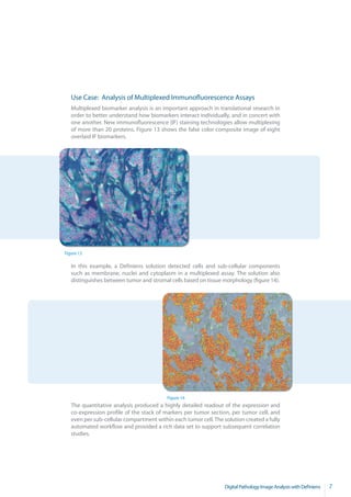 Use Case: Analysis of Multiplexed Immunofluorescence Assays
   Multiplexed biomarker analysis is an important approach in translational research in
   order to better understand how biomarkers interact individually, and in concert with
   one another. New immunofluorescence (IF) staining technologies allow multiplexing
   of more than 20 proteins. Figure 13 shows the false color composite image of eight
   overlaid IF biomarkers.




Figure 13

   In this example, a Definiens solution detected cells and sub-cellular components
   such as membrane, nuclei and cytoplasm in a multiplexed assay. The solution also
   distinguishes between tumor and stromal cells based on tissue morphology (figure 14).




                                          Figure 14
   The quantitative analysis produced a highly detailed readout of the expression and
   co-expression profile of the stack of markers per tumor section, per tumor cell, and
   even per sub-cellular compartment within each tumor cell. The solution created a fully
   automated workflow and provided a rich data set to support subsequent correlation
   studies.




                                                                  Digital Pathology Image Analysis with Definiens   7
 