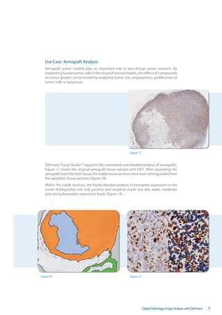 Use Case: Xenograft Analysis
   Xenograft tumor models play an important role in pre-clinical cancer research. By
   implanting human tumor cells in the tissue of animal models, the effects of compounds
   on tumor growth can be tested by analyzing tumor size, angiogenesis, proliferation of
   tumor cells or apoptosis.




                                                           Figure 17



   Definiens Tissue Studio™ supports the automated and detailed analysis of xenografts.
   Figure 17 shows the original xenograft tissue stained with Ki67. After separating the
   xenograft from the host tissue, the viable tissue sections have been distinguished from
   the apoptotic tissue sections (figure 18).
   Within the viable sections, the highly detailed analysis of biomarker expression in the
   nuclei distinguishes not only positive and negative nuclei but also weak, moderate
   and strong biomarker expression levels (figure 19).




Figure 18                                                  Figure 19




                                                                       Digital Pathology Image Analysis with Definiens   9
 