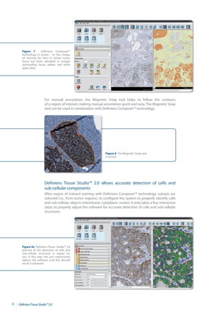 Figure 7        Definiens Composer™
      technology in action – In this image,
      all staining for Her2 in breast tumor
      tissue has been classified in orange;
      surrounding tissue, yellow; and white
      space, blue.




                         For manual annotation, the Magnetic Snap tool helps to follow the contours
                         of a region of interest; making manual annotation quick and easy. The Magnetic Snap
                         tool can be used in combination with Definiens Composer™ technology.




                                                                 Figure 8 The Magnetic Snap tool
                                                                 in action




                         Definiens Tissue Studio™ 2.0 allows accurate detection of cells and
                         sub-cellular components
                         After region of interest training with Definiens Composer™ technology, subsets are
                         selected (i.e., from tumor regions), to configure the system to properly identify cells
                         and sub-cellular objects (membrane, cytoplasm, nuclei). It only takes a few interactive
                         steps to properly adjust the software for accurate detection of cells and sub-cellular
                         structures.




      Figure 9a Definiens Tissue Studio™ 2.0
      preview of the detection of cells and
      sub-cellular structures in breast tis­
      sue. In this step, the user interactively
      adjusts the software until the desired
      result is achieved.




4   DefiniensTissueStudio™2.0
 
