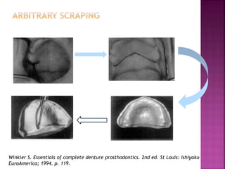 Winkler S. Essentials of complete denture prosthodontics. 2nd ed. St Louis: Ishiyaku
EuroAmerica; 1994. p. 119.
 