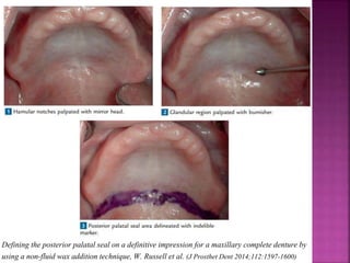 Defining the posterior palatal seal on a definitive impression for a maxillary complete denture by
using a non-fluid wax addition technique, W. Russell et al. (J Prosthet Dent 2014;112:1597-1600)
 