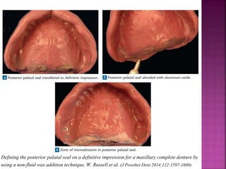 Defining the posterior palatal seal on a definitive impression for a maxillary complete denture by
using a non-fluid wax addition technique, W. Russell et al. (J Prosthet Dent 2014;112:1597-1600)
 