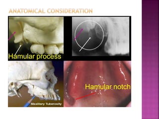 Hamular process
Hamular notch
 