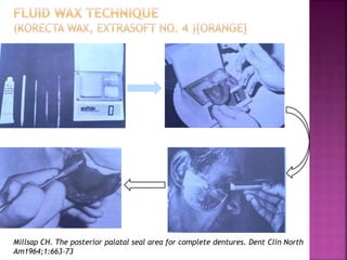 Millsap CH. The posterior palatal seal area for complete dentures. Dent Clin North
Am1964;1:663-73
 