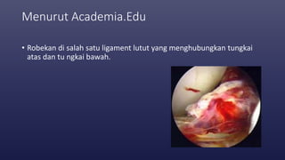 Menurut Academia.Edu
• Robekan di salah satu ligament lutut yang menghubungkan tungkai
atas dan tu ngkai bawah.
 