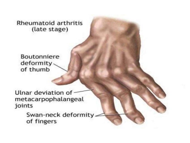 Rheumatoid Arthritis Rheumatoid arthritis