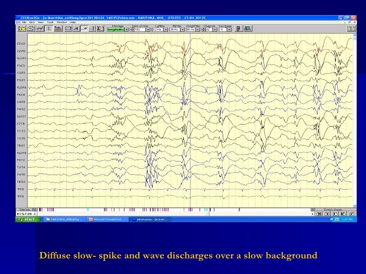 Definition and natural history of Lennox Gastaut syndrome