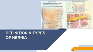 DEFINITION & TYPES
OF HERNIA
1
 