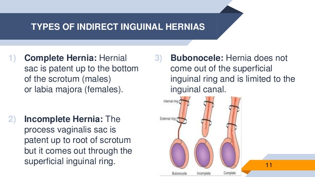 Definition and types of hernia repair