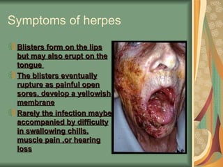 Definition of herpes | PPT