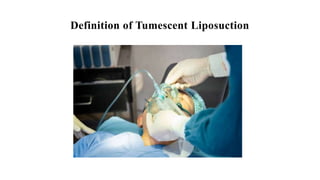 Definition of Tumescent Liposuction
 