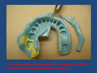 Trim the excess impression 5.0 mm above the finish
line and at the area of palate or tongue
 