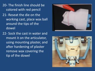 20- The finish line should be
colored with red pencil
21- Reseat the die on the
working cast, place wax ball
around the tips of the
dowel
22- Sock the cast in water and
mount it on the articulator,
using mounting plaster, and
after hardening of plaster
remove wax covering the
tip of the dowel
 