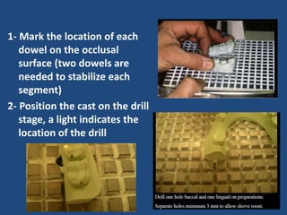 1- Mark the location of each
dowel on the occlusal
surface (two dowels are
needed to stabilize each
segment)
2- Position the cast on the drill
stage, a light indicates the
location of the drill
 