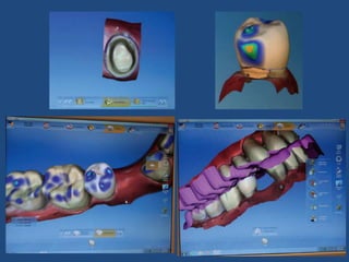 Definitive casts and dies