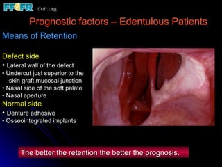 Prognostic factors – Edentulous Patients Means of Retention Defect side Lateral wall of the defect Undercut just superior to the  skin graft mucosal junction Nasal side of the soft palate Nasal aperture Normal side Denture adhesive Osseointegrated implants The better the retention the better the prognosis . 