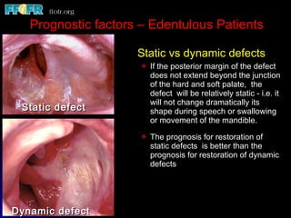 Prognostic factors – Edentulous Patients Static vs dynamic defects If the posterior margin of the defect  does not extend beyond the junction of the hard and soft palate,  the defect  will be relatively static - i.e. it will not change dramatically its shape during speech or swallowing or movement of the mandible. The prognosis for restoration of static defects  is better than the prognosis for restoration of dynamic defects Static defect Dynamic defect 