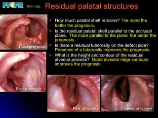 How much palatal shelf remains?  The more the better the prognosis . Is the residual palatal shelf parallel to the occlusal plane.  The more parallel to the plane  the better the prognosis. Is there a residual tuberosity on the defect side?  Presence of a tuberosity improves the prognosis. What is the height and contour of the residual alveolar process?  Good alveolar ridge contours improves the prognosis.  Residual palatal structures Good prognosis Poor prognosis Poor prognosis Good prognosis 