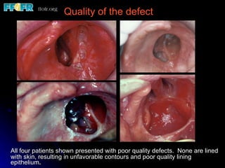 All four patients shown presented with poor quality defects.  None are lined with skin, resulting in unfavorable contours and poor quality lining epithelium . Quality of the defect 