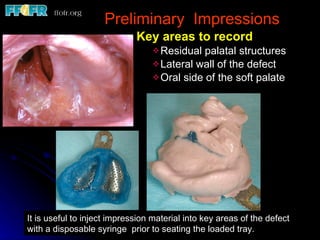 Preliminary  Impressions Key areas to record Residual palatal structures Lateral wall of the defect Oral side of the soft palate It is useful to inject impression material into key areas of the defect with a disposable syringe  prior to seating the loaded tray. 