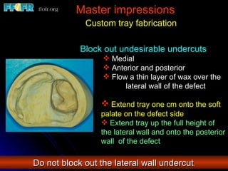 Master impressions Custom tray fabrication Block out undesirable undercuts Medial Anterior and posterior Flow a thin layer of wax over the  lateral wall of the defect Extend tray one cm onto the soft palate on the defect side Extend tray up the full height of the lateral   wall and onto the posterior wall  of the defect Do not block out the lateral wall undercut . 