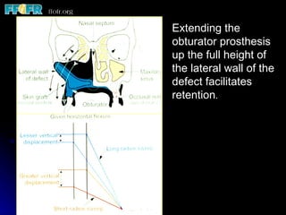Extending the obturator prosthesis up the full height of the lateral wall of the defect facilitates retention . 