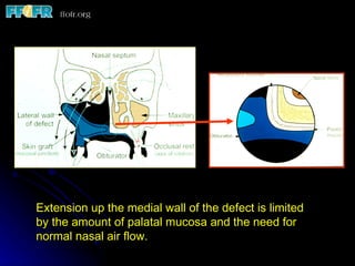 Extension up the medial wall of the defect is limited by the amount of palatal mucosa and the need for normal nasal air flow. 
