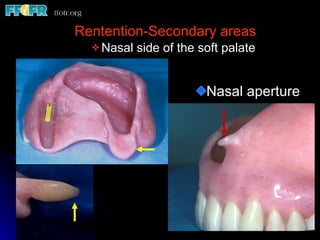 Rentention-Secondary areas Nasal side of the soft palate Nasal aperture 