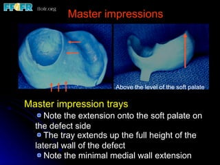 Master impressions Master impression trays Note the extension onto the soft palate on the defect side The tray extends up the full height of the lateral wall of the defect Note the minimal medial wall extension Above the level of the soft palate 