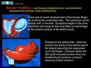 Border molding -  Low fusing compounds are  recommended because they provide  more working time. Take care to avoid displacement of the tissues Begin by molding the unresected side.  The extension up the medial wall  is minimal.  Excessive height in this area interferes with nasal air flow and offers no advantage in the anterior portion of the defect (oval). Proceed to the defect side.  Mold the anterior two thirds of the lateral wall of the defect extending the impression up its full height.  Contours below the skin graft mucosal junction (line) are dictated by lip contours, contours above by cheek contours. 