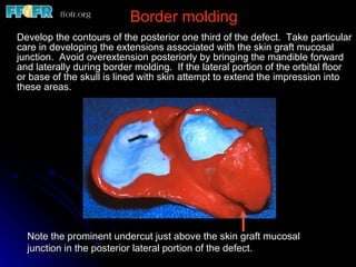 Border molding Develop the contours of the posterior one third of the defect.  Take particular care in developing the extensions associated with the skin graft mucosal junction.  Avoid overextension posteriorly by bringing the mandible forward and laterally during border molding.  If the lateral portion of the orbital floor or base of the skull is lined with skin attempt to extend the impression into these areas. Note the prominent undercut just above the skin graft mucosal junction in the posterior lateral portion of the defect. 