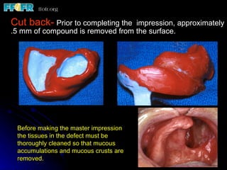 Cut back-   Prior to completing the  impression, approximately .5 mm of compound is removed from the surface.  Before making the master impression the tissues in the defect must be thoroughly cleaned so that mucous accumulations and mucous crusts are removed. 