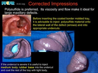 Corrected Impressions Polysulfide is preferred.  Its viscosity and flow make it ideal for large maxillary defects. Before inserting the coated border molded tray, it is advisable to inject  polysulfide material onto the lateral wall of the defect (arrows) and into appropriate undercuts. If the undercut is severe it is useful to inject  medium body rubber base  into the undercut and coat the rest of the tray with light body. 