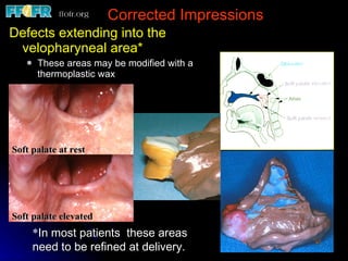 Corrected Impressions Defects extending into the velopharyneal area* These areas may be modified with a thermoplastic wax * In most patients  these areas need to be refined at delivery. Soft palate at rest Soft palate elevated 