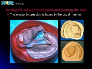 Boxing the master impression and pouring the cast The master impression is boxed in the usual manner 