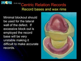 Centric Relation Records Record bases and wax rims Minimal blockout should be used for the lateral wall of the defect.  If excessive block out is employed the record base will be very unstable making it difficult to make accurate records. 