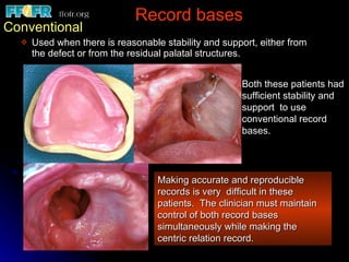 Record bases   Conventional Used when there is reasonable stability and support, either from the defect or from the residual palatal structures. Both these patients had sufficient stability and  support  to use conventional record bases. Making accurate and reproducible records is very  difficult in these patients.  The clinician must maintain control of both record bases simultaneously while making the  centric relation record. 