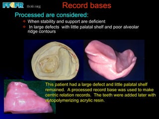 Record bases Processed are considered: When stability and support are deficient In large defects  with little palatal shelf and poor alveolar ridge contours This patient had a large defect and little palatal shelf remained.  A processed record base was used to make centric relation records.  The teeth were added later with autopolymerizing acrylic resin. 