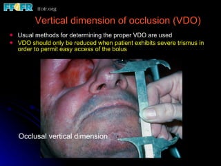 Vertical dimension of occlusion (VDO) Usual methods for determining the proper VDO are used VDO should only be reduced when patient exhibits severe trismus in order to permit easy access of the bolus Occlusal vertical dimension 