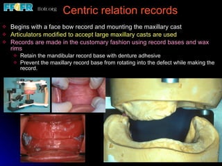 Centric relation records Begins with a face bow record and mounting the maxillary cast Articulators modified to accept large maxillary casts are used Records are made in the customary fashion using record bases and wax rims Retain the mandibular record base with denture adhesive Prevent the maxillary record base from rotating into the defect while making the record. 