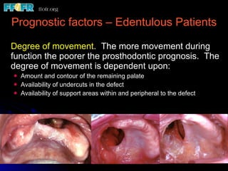 Prognostic factors – Edentulous Patients Degree of movement .  The more movement during function the poorer the prosthodontic prognosis.  The degree of movement is dependent upon: Amount and contour of the remaining palate Availability of undercuts in the defect Availability of support areas within and peripheral to the defect 