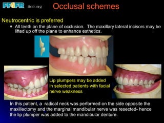 Occlusal schemes Neutrocentric is preferred All teeth on the plane of occlusion.  The maxillary lateral incisors may be lifted up off the plane to enhance esthetics. Lip plumpers may be added in selected patients with facial nerve weakness In this patient, a  radical neck was performed on the side opposite the  maxillectomy and the marginal mandibular nerve was resected- hence the lip plumper was added to the mandibular denture. 