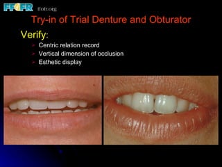 Try-in of Trial Denture and Obturator Verify : Centric relation record Vertical dimension of occlusion Esthetic display 