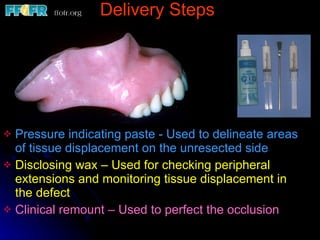 Pressure indicating paste - Used to delineate areas of tissue displacement on the unresected side Disclosing wax – Used for checking peripheral extensions and monitoring tissue displacement in the defect Clinical remount – Used to perfect the occlusion Delivery Steps 