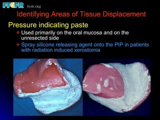 Identifying Areas of Tissue Displacement Pressure indicating paste Used primarily on the oral mucosa and on the unresected side Spray silicone releasing agent onto the PIP in patients with radiation induced xerostomia 